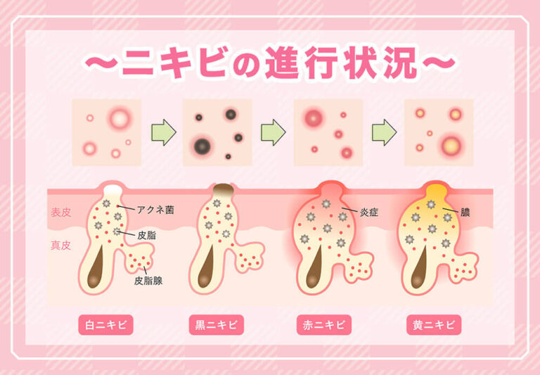 黄ニキビは潰す？自然に治す？正しい治し方や治る期間も解説！
